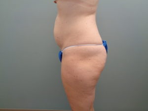 Tummy Tuck Before & After Pictures in Nashville, TN