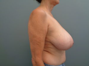 Breast Reduction Before & After Pictures Nashville, TN