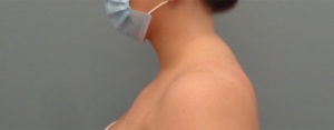 Liposuction Before and After Pictures Nashville, TN