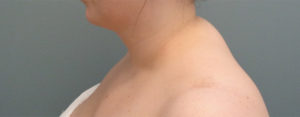 Liposuction Before and After Pictures Nashville, TN