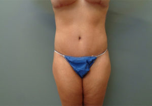 Tummy Tuck Before & After Pictures in Nashville, TN