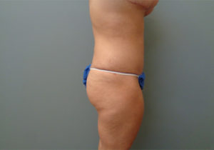 Tummy Tuck Before & After Pictures in Nashville, TN