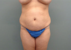 Tummy Tuck Before & After Pictures in Nashville, TN