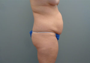 Tummy Tuck Before & After Pictures in Nashville, TN