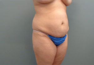 Tummy Tuck Before & After Pictures in Nashville, TN