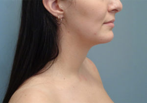 Chin Augmentation Before & After Pictures in Nashville, TN