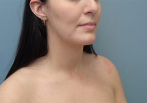 Chin Augmentation Before & After Pictures in Nashville, TN