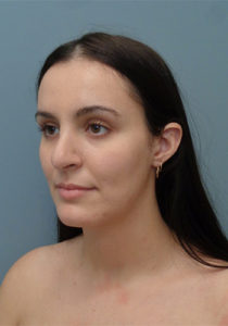 Rhinoplasty Before and After Pictures Nashville, TN