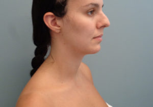 Chin Augmentation Before & After Pictures in Nashville, TN