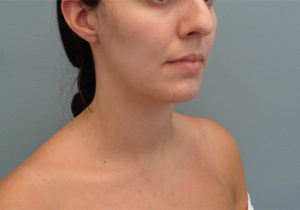 Chin Augmentation Before & After Pictures in Nashville, TN