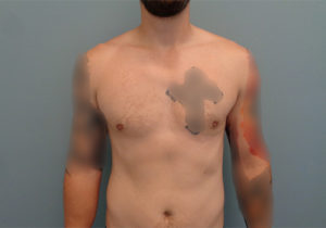 Gynecomastia Before & After Pictures in Nashville, TN