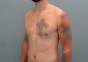 Gynecomastia Before & After Pictures in Nashville, TN