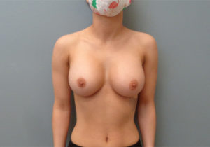 Breast Augmentation Before & After Pictures in Nashville, TN