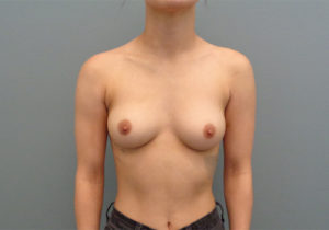 Breast Augmentation Before & After Pictures in Nashville, TN