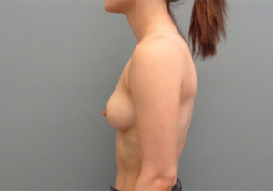 Breast Augmentation Before & After Pictures in Nashville, TN