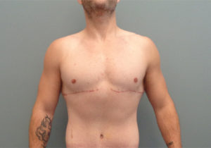 Gynecomastia Before & After Pictures in Nashville, TN