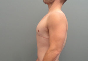 Gynecomastia Before & After Pictures in Nashville, TN