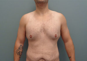 Gynecomastia Before & After Pictures in Nashville, TN