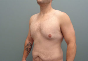 Gynecomastia Before & After Pictures in Nashville, TN