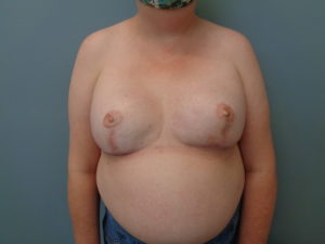 Breast Reduction Before & After Pictures in Nashville, TN