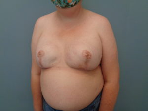 Breast Reduction Before & After Pictures in Nashville, TN