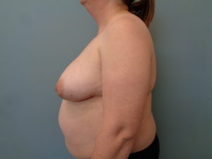 Breast Reduction Before & After Pictures in Nashville, TN