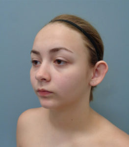 Otoplasty Before and After Pictures Nashville, TN