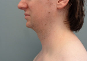 Chin Augmentation Before & After Pictures in Nashville, TN