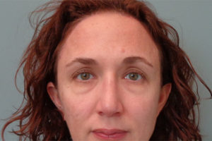 Brow Lift Before and After Pictures in Nashville, TN