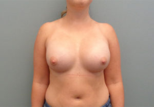 Breast Augmentation Before & After Pictures in Nashville, TN