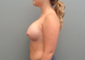 Breast Augmentation Before & After Pictures in Nashville, TN