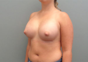 Breast Augmentation Before & After Pictures in Nashville, TN