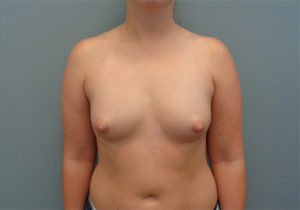 Breast Augmentation Before & After Pictures in Nashville, TN