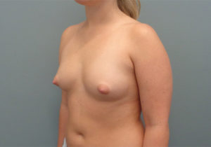 Breast Augmentation Before & After Pictures in Nashville, TN