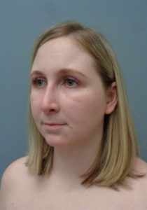 Rhinoplasty Before & After Pictures in Nashville, TN