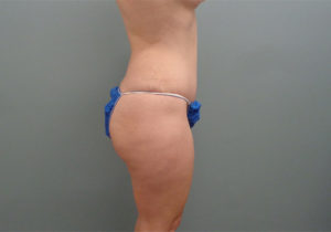 Tummy Tuck Before & After Pictures in Nashville, TN