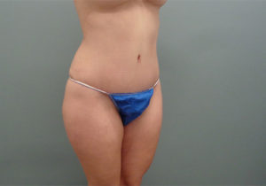 Tummy Tuck Before & After Pictures in Nashville, TN