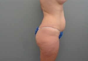 Tummy Tuck Before & After Pictures in Nashville, TN