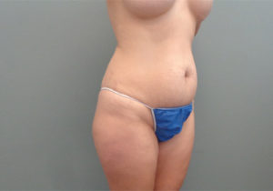 Tummy Tuck Before & After Pictures in Nashville, TN