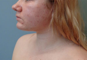 Chin Augmentation Before & After Pictures in Nashville, TN