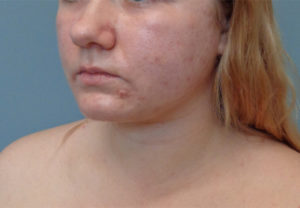 Chin Augmentation Before & After Pictures in Nashville, TN