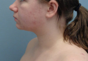 Chin Augmentation Before & After Pictures in Nashville, TN