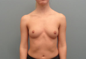 Breast Augmentation Before & After Pictures in Nashville, TN