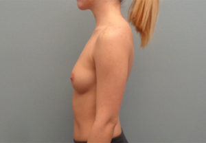 Breast Augmentation Before & After Pictures in Nashville, TN