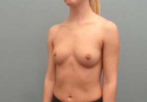 Breast Augmentation Before & After Pictures in Nashville, TN