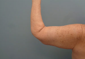 Arm Lift Before & After Pictures in Nashville, TN