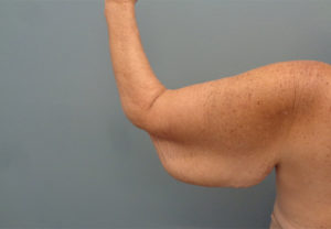 Arm Lift Before & After Pictures in Nashville, TN