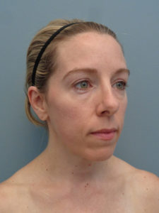 Rhinoplasty Before & After Pictures in Nashville, TN