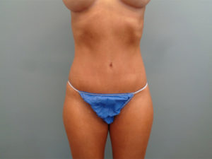 TUMMY TUCK BEFORE & AFTER PICTURES IN NASHVILLE, TN