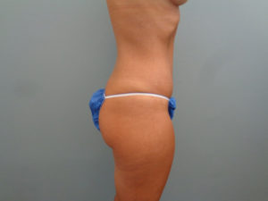 TUMMY TUCK BEFORE & AFTER PICTURES IN NASHVILLE, TN